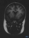 Kernspintomographie Kopf frontal