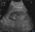 Ultraschall der Niere
